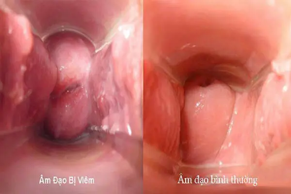 Hình ảnh khí hư màu trắng sữa do viêm vùng chậu