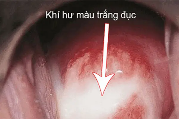 Khí hư có màu trắng sữa do viêm âm đạo