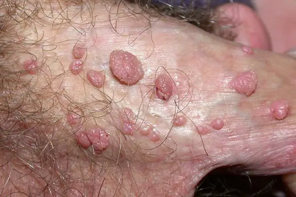 Hình ảnh mụn cóc sinh dục ở nam giới có nguy hiểm không?