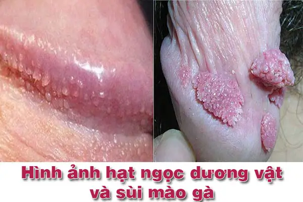 Dấu hiệu nhận biết hình ảnh mụn cóc sinh dục ở nam giới