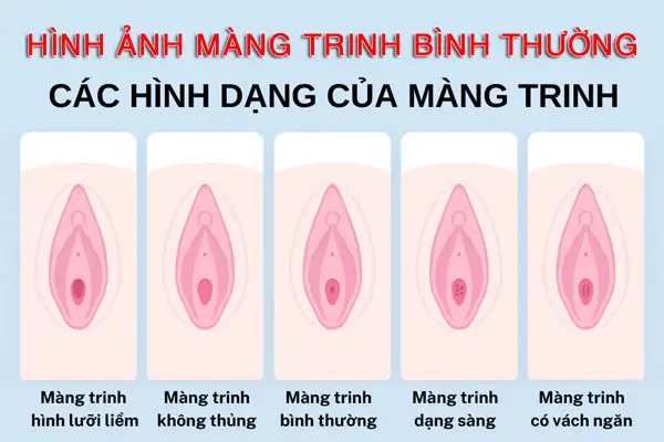 Hình ảnh màng trinh bình thường