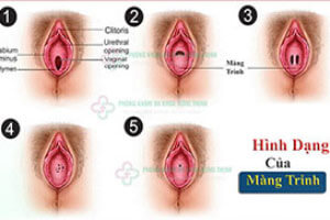 Hình ảnh màng trinh bình thường thật của con gái vị trí màng trinh