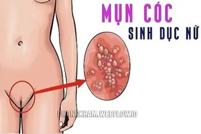 Hình ảnh mụn cóc sinh dục ở nữ qua từng giai đoạn cách chữa