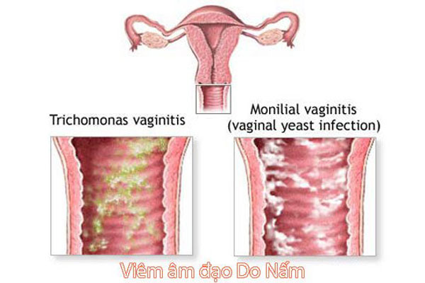 Hình ảnh ngứa vùng kín ở nữ giới do nhiễm nấm âm đạo