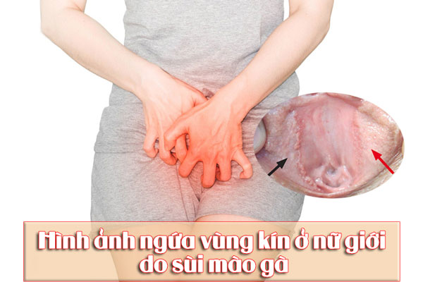 Hình ảnh ngứa vùng kín ở nữ giới do sùi mào gà