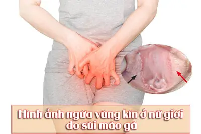 Hình ảnh ngứa vùng kín ở nữ giới, nam giới BS Tư vấn