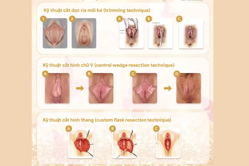 Hình ảnh trước và sau khi cắt môi bé thu nhỏ vùng kín