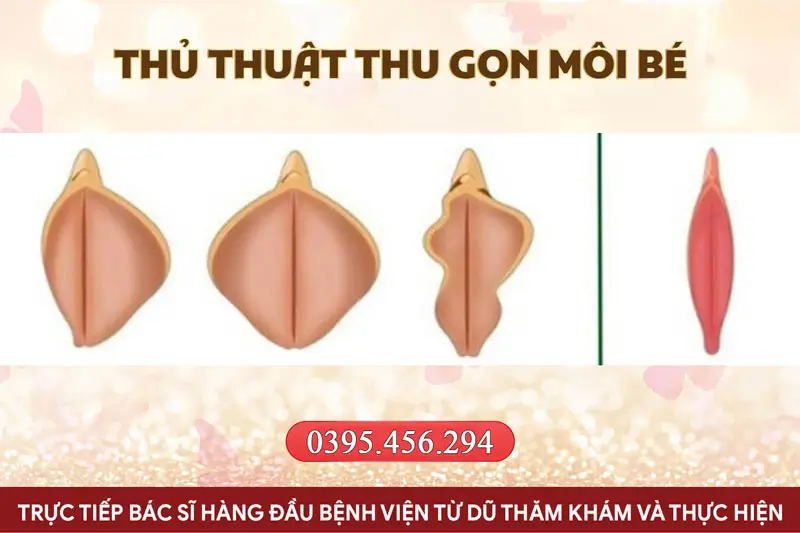 Hình ảnh trước và sau thủ thuật cô bé