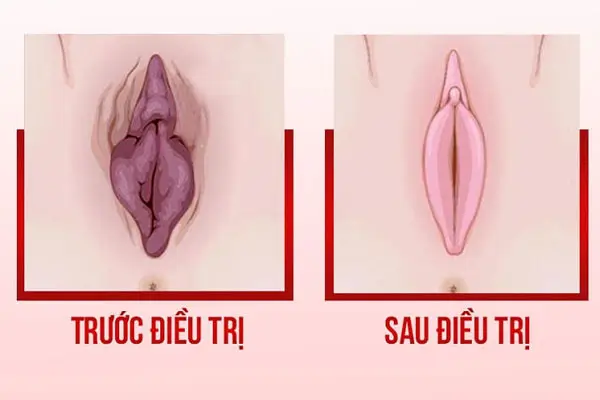 Hình ảnh trước và sau phẫu thuật cô bé