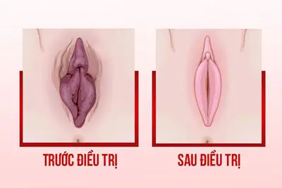 20 Hình ảnh trước và sau khi cắt môi bé thu nhỏ vùng kín