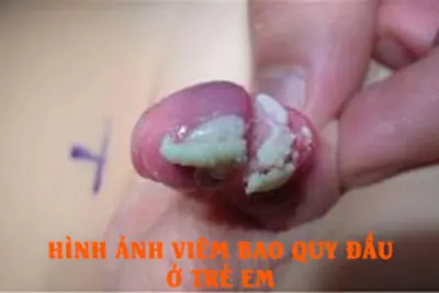 Hình ảnh viêm bao quy đầu ở trẻ em