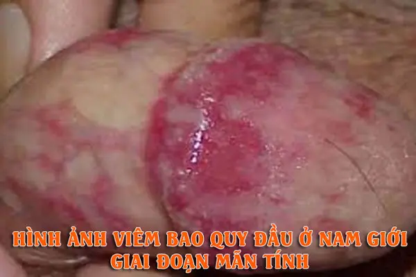 Hình ảnh viêm bao quy đầu ở nam giới giai đoạn mãn tính