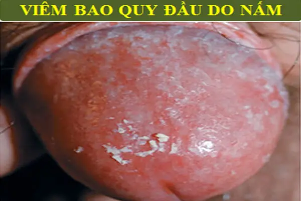 Hình ảnh viêm nhiễm bHình ảnh viêm nhiễm bao quy đầu do nấm Candidaao quy đầu do nấm Candida