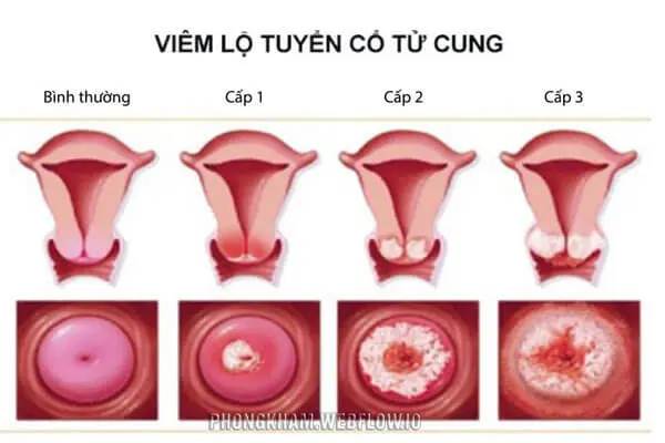 Hình ảnh viêm lộ tuyến cổ tử cung nữ giới qua từng giai đoạn