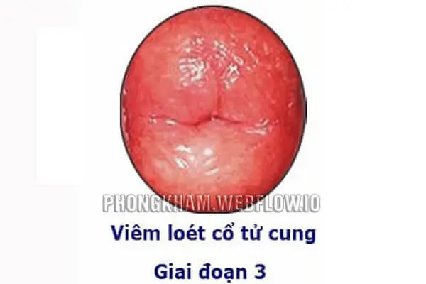 Hình ảnh viêm lộ tuyến cổ tử cung độ 3