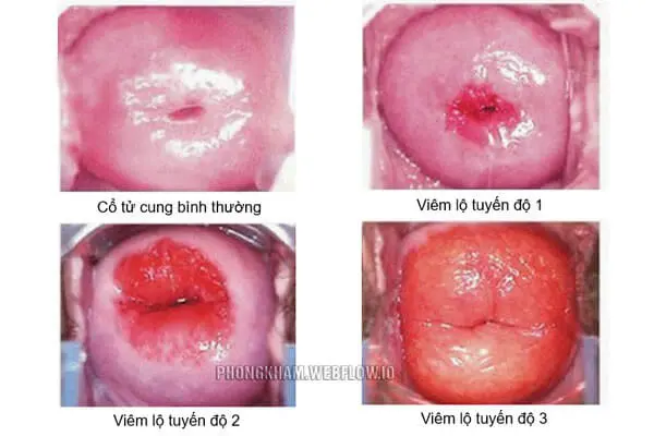 Viêm lộ tuyến cổ tử cung gây ra những ảnh hưởng gì?