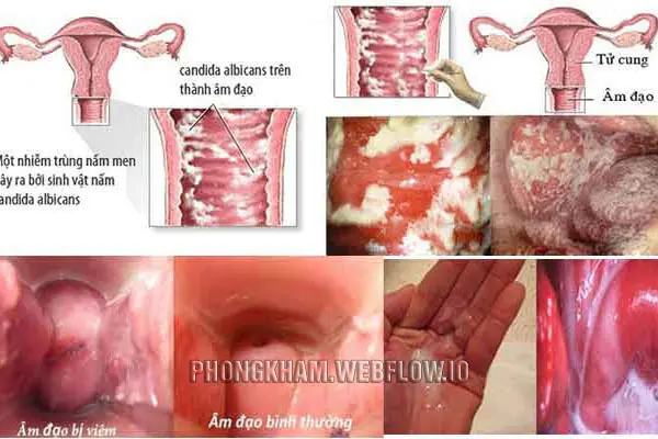 Hình ảnh viêm âm đạo do nấm men Candida