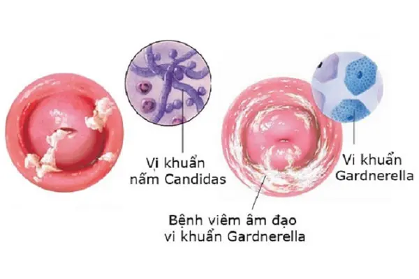 Hình ảnh viêm âm đạo do vi khuẩn