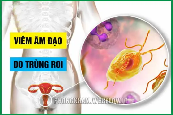 Hình ảnh viêm âm đạo do trùng roi Trichomonas 
