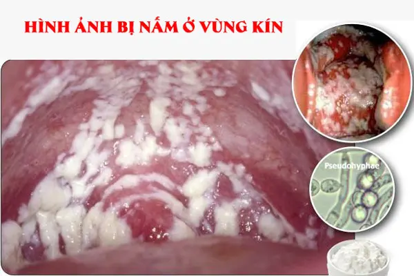 Hình ảnh bị nấm ở vùng kín