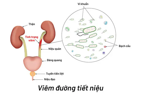 Khám viêm đường tiết niệu như thế nào? BS Trần thị Thành giải đáp