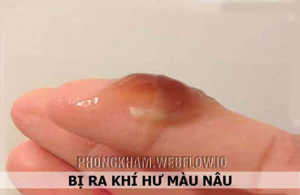 Nguyên nhân khí hư có 1 ít sợi máu là gì?