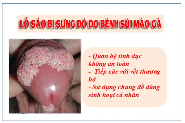Lỗ sáo bị sưng đỏ là dấu hiệu của bệnh sùi mào gà