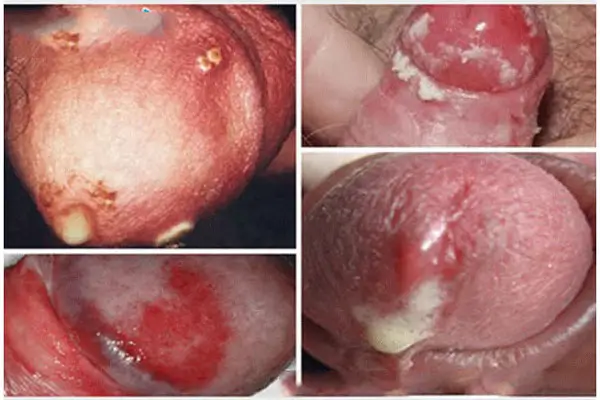Hình ảnh lở loét nổi mụn ở bao quy đầu do giang mai