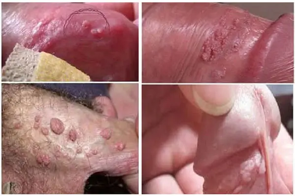 Hình ảnh lở loét nổi mụn ở bao quy đầu do sùi mào gà