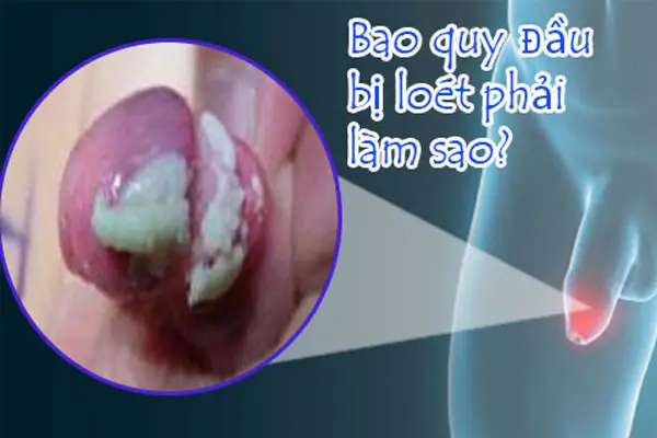Ảnh hưởng của lở loét bao quy đầu đến sức khỏe nam giới