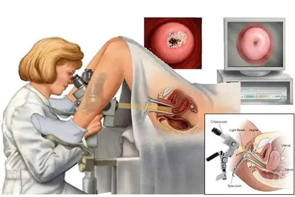 Điều trị viêm lộ tuyến cổ tử cung bằng y học hiện đại