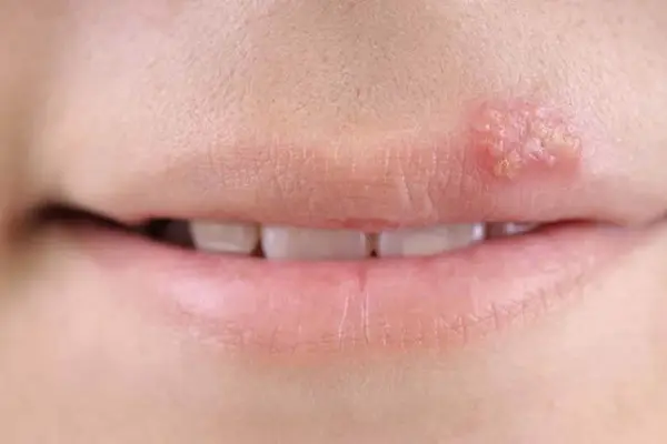 Hình ảnh mụn rộp sinh dục ở môi