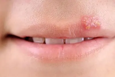 Mụn rộp sinh dục ở miệng là gì? hình ảnh triệu chứng cách phòng và chữa bệnh