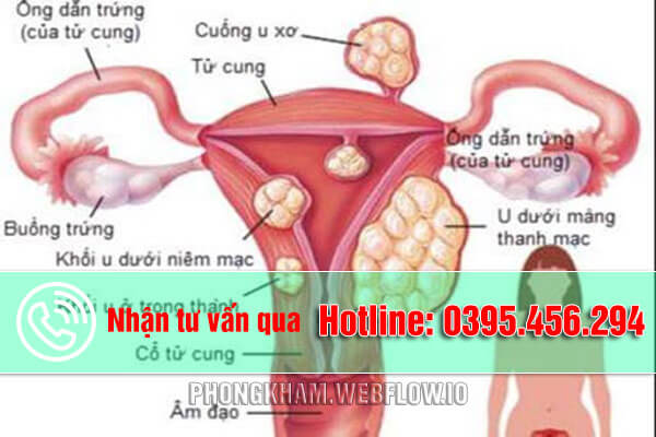Nguyên nhân triệu chứng thường gặp của bệnh u xơ cổ tử cung