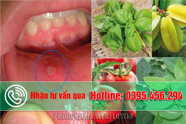 Nhiệt miệng nên ăn gì, uống gì nhanh khỏi?