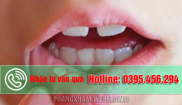 Nhiệt miệng ăn, uống gì nhanh khỏi [12 cách chữa tự nhiên an toàn]