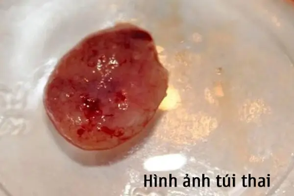 Sau khi uống thuốc phá thai bao lâu thì ra túi thai?