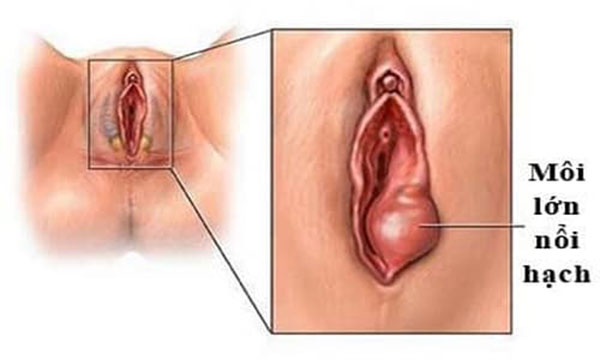 Cách điều trị nổi hạch ở vùng kín hiệu quả