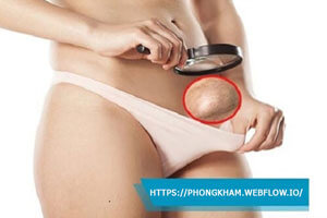 Nổi hạch ở vùng kín nữ gây đau nguyên nhân cách điều trị hiệu quả