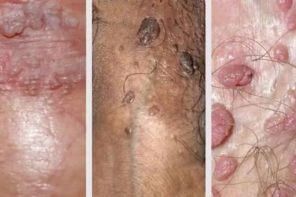 Bị nổi nốt ngứa ở bìu tinh hoàn do Bệnh sùi mào gà