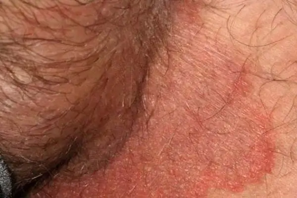 Cách điều trị nốt ngứa ở bìu hiệu quả và an toàn