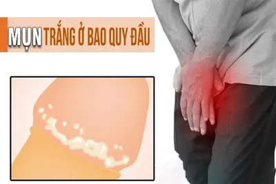 Nổi mụn trắng ở bao quy đầu là bệnh gì?
