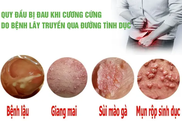 Quy đầu bị đau khi cương cứng do bệnh lây truyền qua đường tình dục
