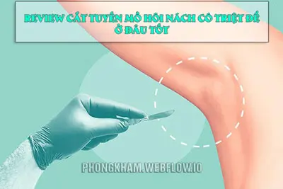 Review cắt tuyến mồ hôi nách có hiệu quả không, có an toàn không?
