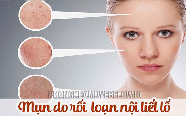Ảnh hưởng của rối loạn nội tiết tố nam gây mụn