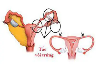 Siêu âm có phát hiện tắc vòi trứng không? BS Giải Đáp