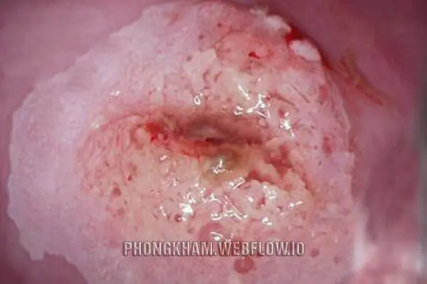 Cách điều trị sùi mào gà cổ tử cung tại phòng khám Hưng Thịnh