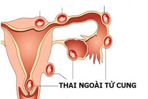 Thai ngoài tử cung thử que có lên vạch không có giữ được thai không