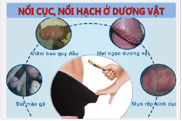 Cách chữa tình trạng nổi hạch nổi cục u ở thân dương vật