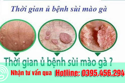 Thời gian ủ bệnh sùi mào gà là bao lâu? [Giải đáp chi tiết]